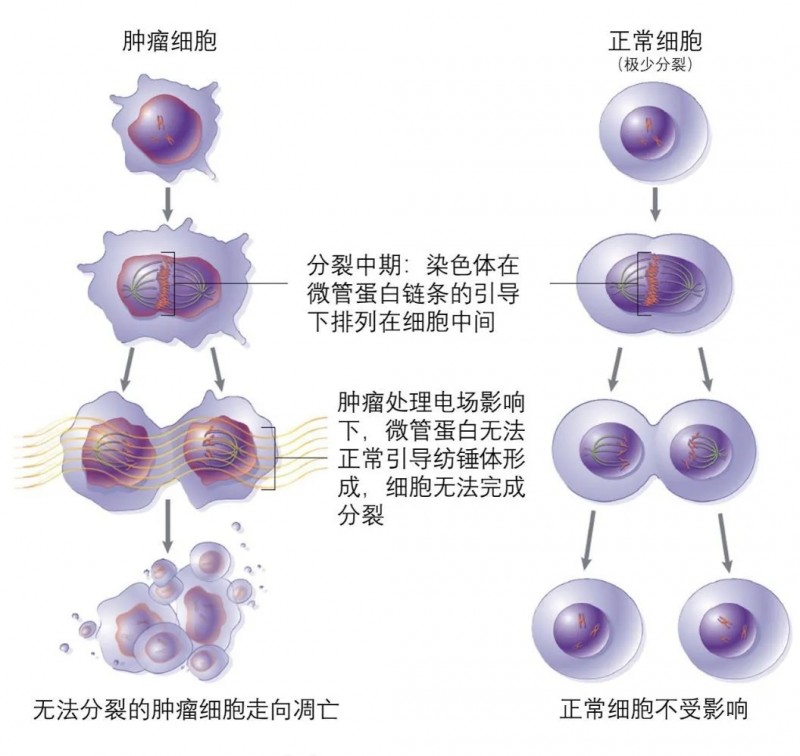 Optune识别并杀死癌细胞